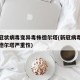 新型冠状病毒变异毒株德尔塔(新冠病毒变异毒株德尔塔严重性)